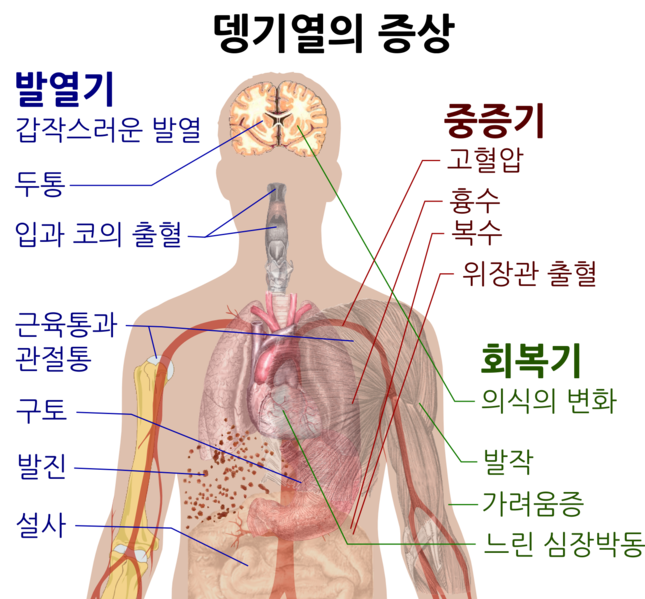 파일:뎅기열증상.png