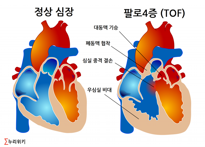 파일:팔로4증.png