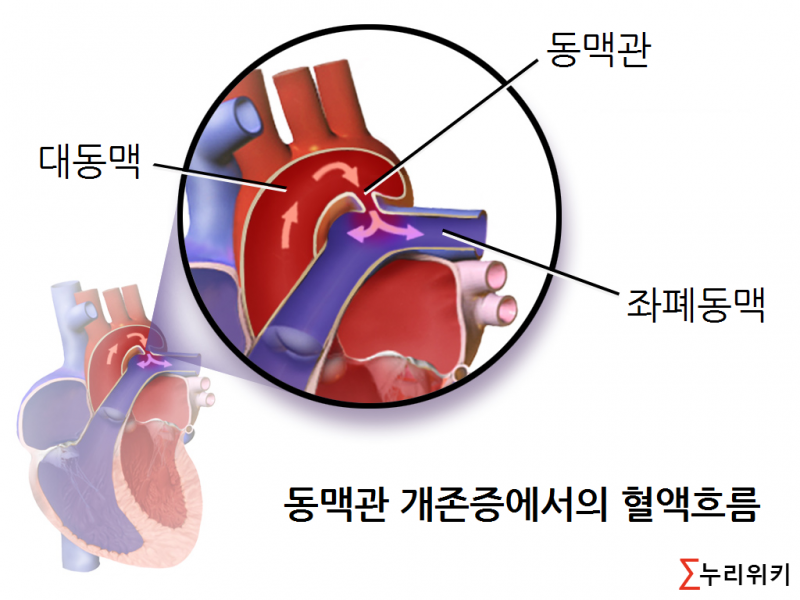 파일:동맥관개존증.png