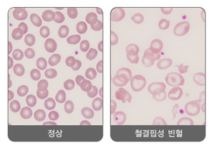 철결핍성빈혈.png