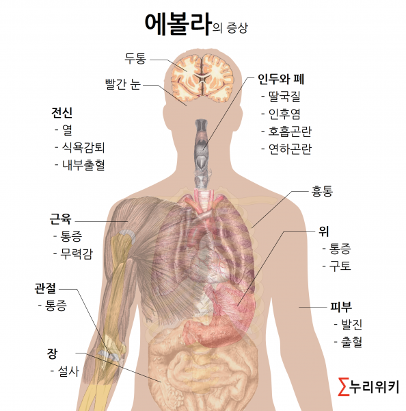 파일:에볼라의증상.png